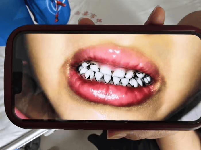 家长接到劝返电话“回甘肃去治”,幼儿血铅中毒事件更多细节曝光